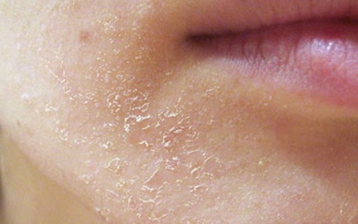 TẠI SAO NÊN SỬ DỤNG VASELINE TRONG CHĂM SÓC DA VÀ SỨC KHỎE?